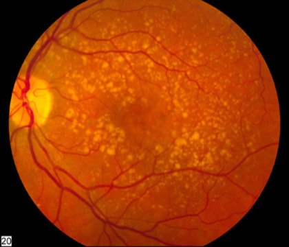 Intermediate AMD (drusen)