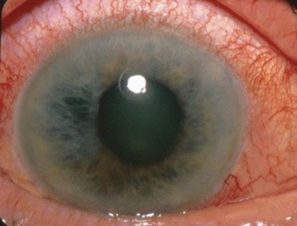 Acute angle-closure glaucoma