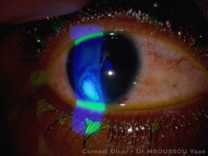 Bacterial keratitis