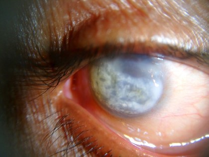 Band keratopathy
