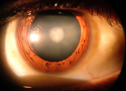 Mature cataract
