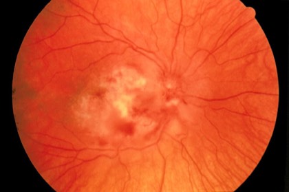CMV retinitis