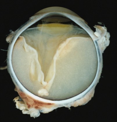 Coats disease (pathology)
