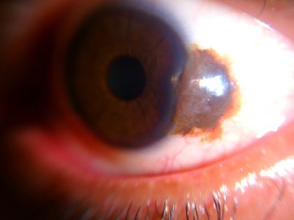 Conjunctival nevus
