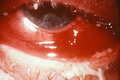 Hyperacute conjunctivitis