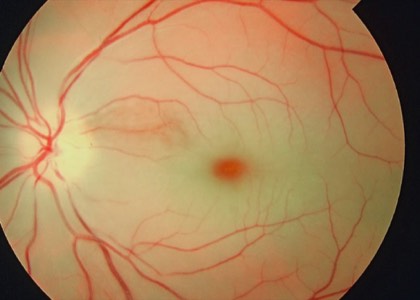 Central retinal artery occlusion