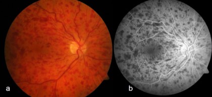 Central retinal vein occlusion