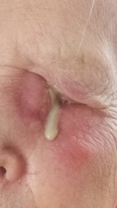 Acute dacryocystitis