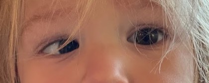 Accommodative esotropia