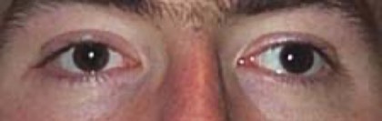 Exotropia