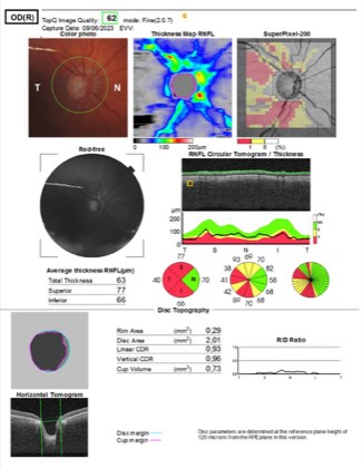 Glaucomatous optic neuropathy (OCT)