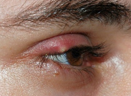 Hordeolum (stye)