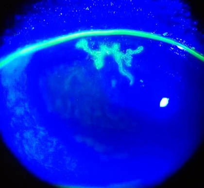 HSV dendritic keratitis
