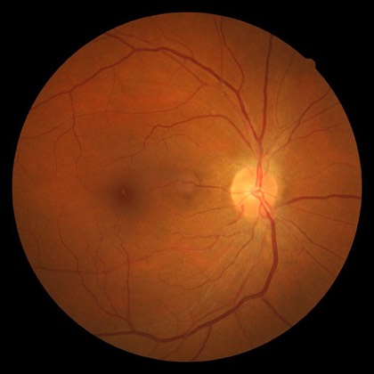 Hypertensive retinopathy
