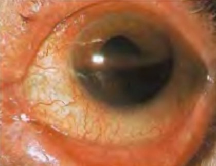 Hyphema