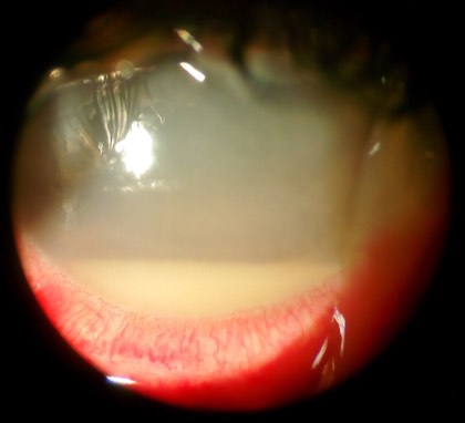 Hypopyon