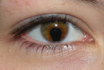 Iris coloboma