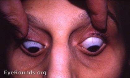 Keratoconus (Munson sign)