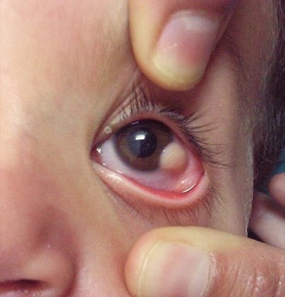 Limbal dermoid