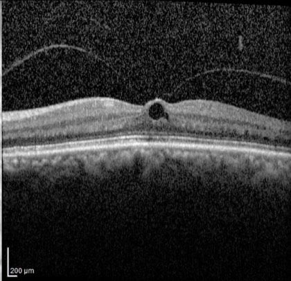 OCT — macular hole