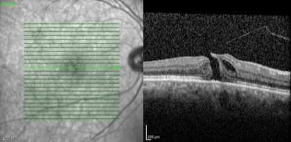 Macular hole