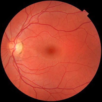 Normal fundus