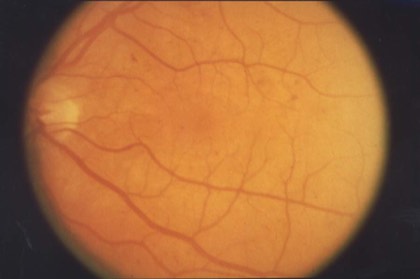 Non-proliferative diabetic retinopathy