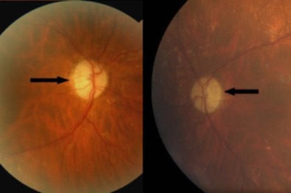 Optic atrophy