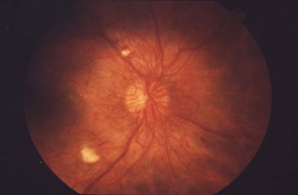 Proliferative diabetic retinopathy