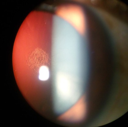 Posterior subcapsular cataract