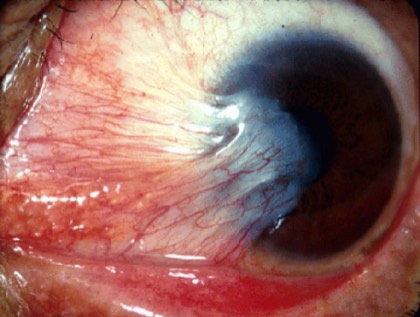 Pterygium
