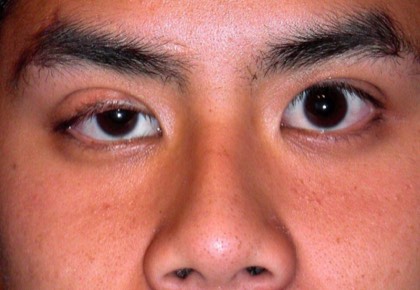 Congenital ptosis