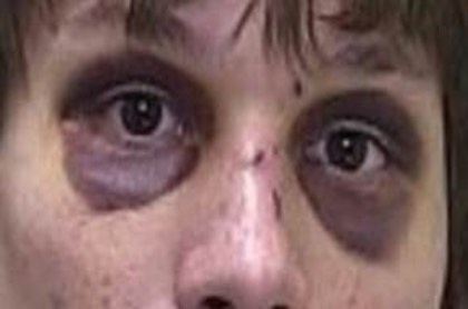 Periorbital ecchymosis