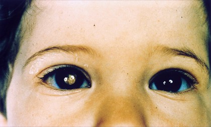 Leukocoria (retinoblastoma)