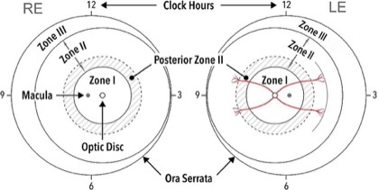 ROP zones (diagram)
