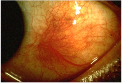 Scleritis
