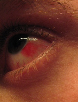 Subconjunctival hemorrhage