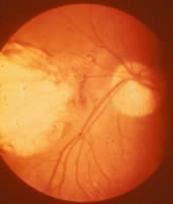 Toxoplasma retinochoroiditis