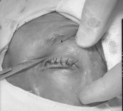 Trachoma (TT)