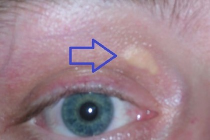 Xanthelasma